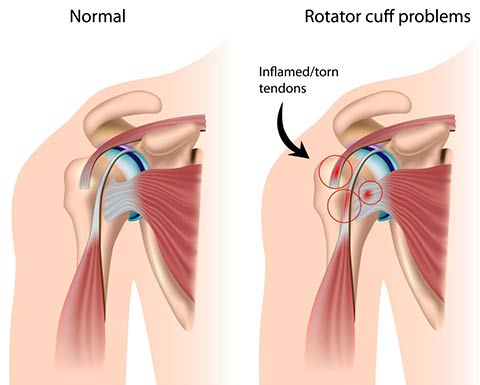 rotator-cuff-problems- arthroscopic-surgery